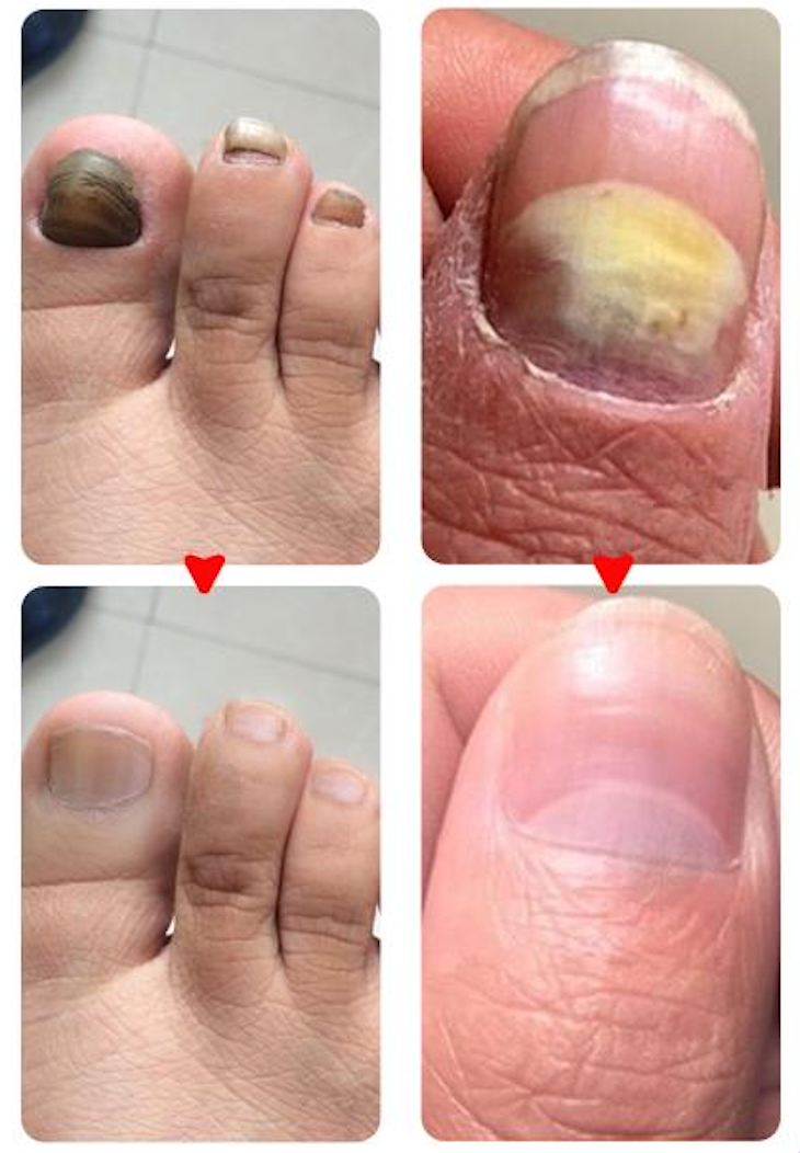 Traitement anti-mycoses des ongles (7 jours).