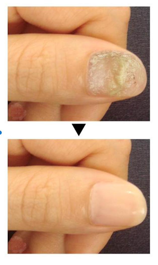 Traitement anti-mycoses des ongles (7 jours).