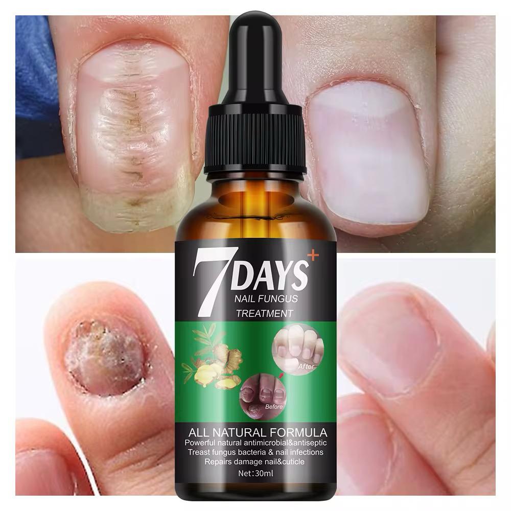Traitement anti-mycoses des ongles (7 jours).
